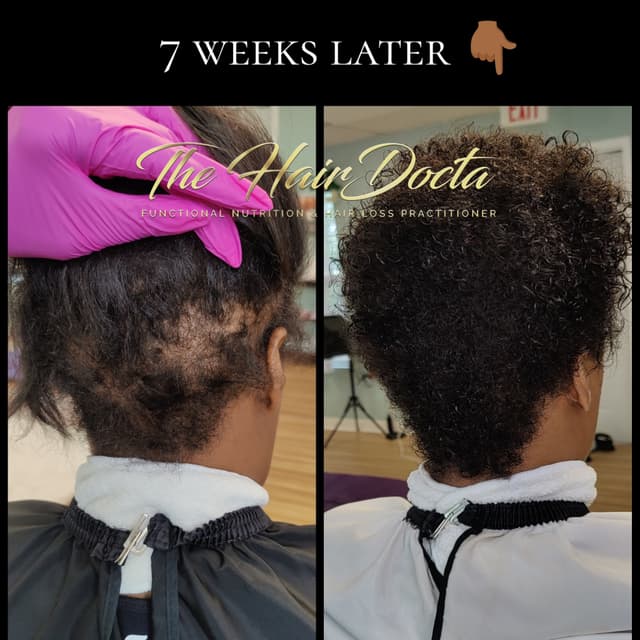 Luxury Density Treatment at The Hairdocta Clinic in Kansas City, MO